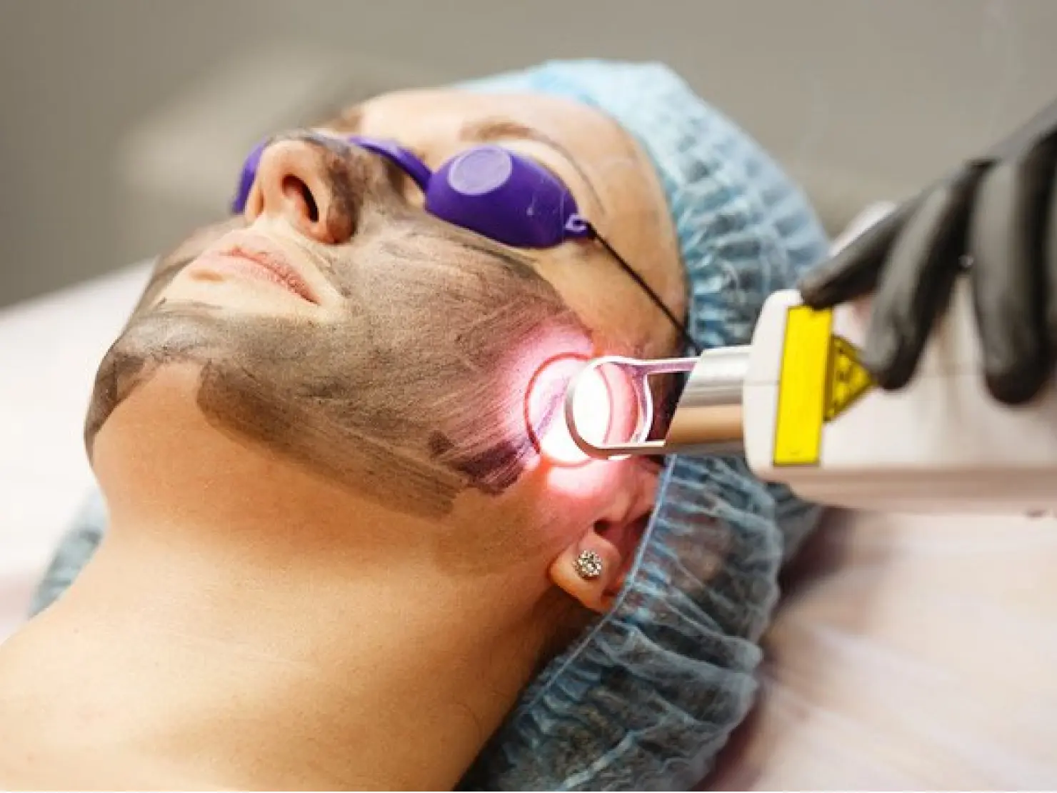 Laser Treatment